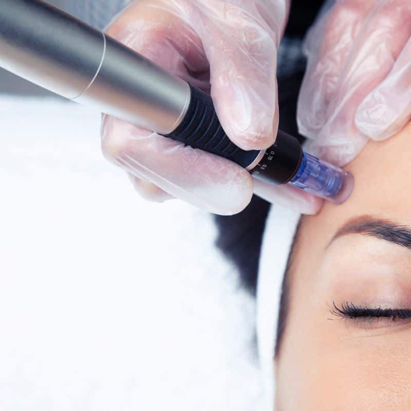 Morpheus8 treatment Nazeing from Lipo Sculpt - Book in today!