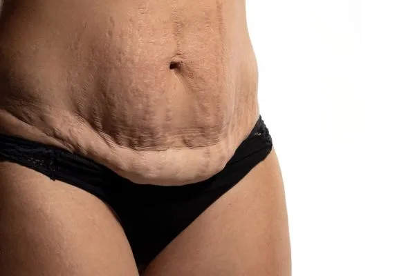 Lost the Weight but Not the Loose Skin? 1 image of womans stomach after weight loss showing loose skin Nazeing