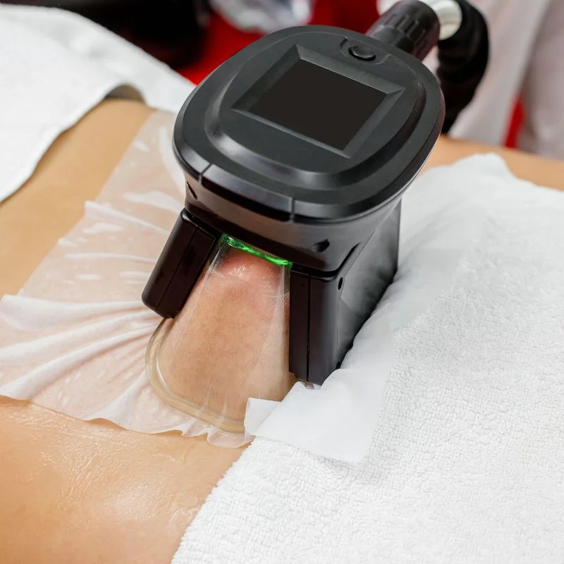 Fat Freezing treatment Nazeing